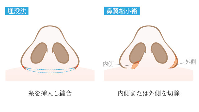 鼻翼を縮小する手術