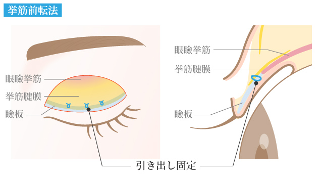 瞼裂を拡大する手術
